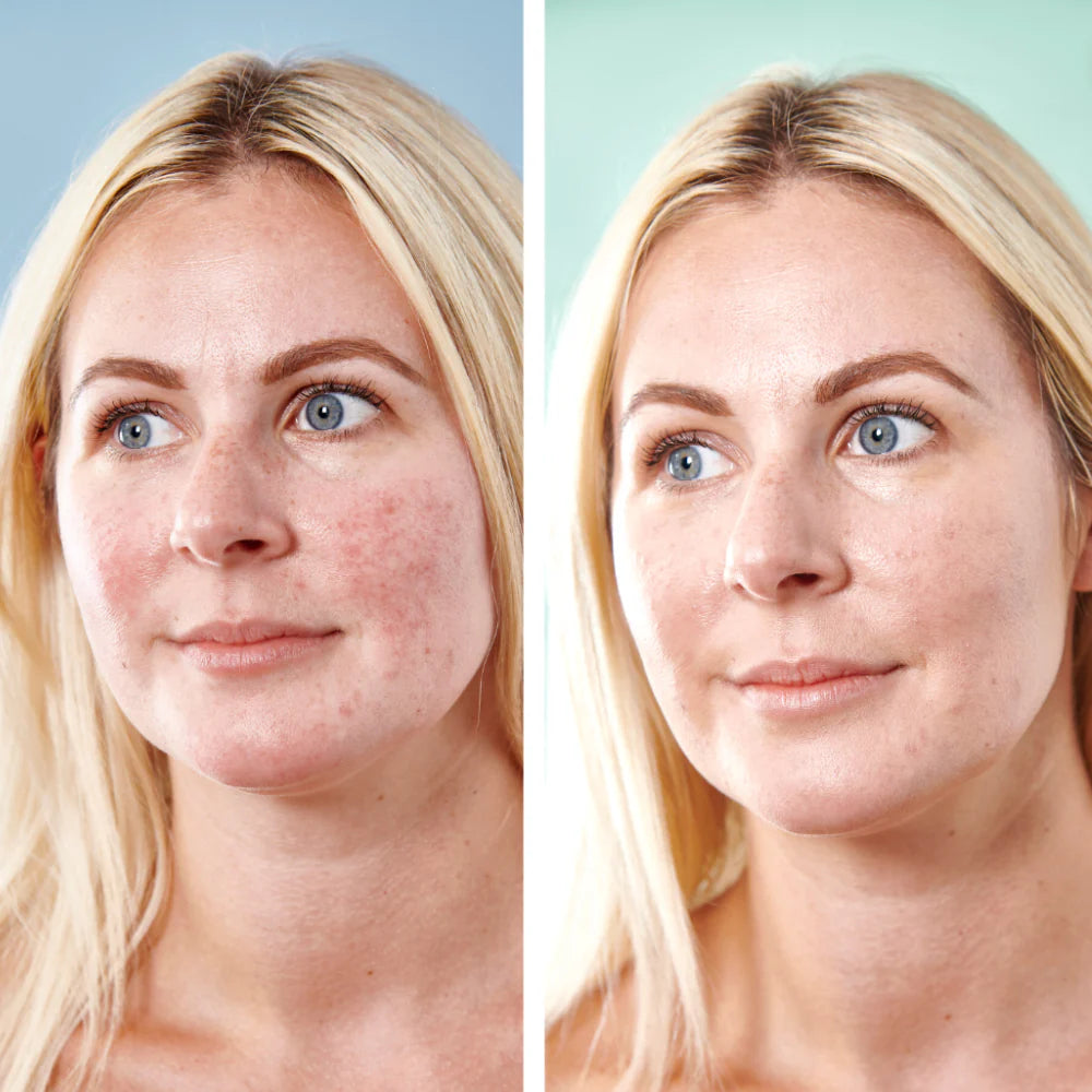 Sorted Skin 5 in 1 Anti-Redness Day Cream SPF50 - 30 ml.